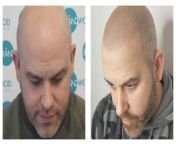 Yorkshire based Hairline Back is pioneering a highly specialised form of medical tattooing to give hair loss sufferers a shaved stubble look.&#60;br/&#62;And the revolutionary ‘life changing’ process is getting five-star reviews.&#60;br/&#62;Thrilled customers on its hairlineback.co.uk website say the natural hair loss technique - called scalp micropigmentation or (SMP) and the results seen here - is boosting their confidence and makes them feel years younger.&#60;br/&#62;It can also be used in-between thinning hair to add fullness, suitable for both men and women, says Barnsley business owner Kate McBride.&#60;br/&#62;For more details and bookings visit www,hairlineback.co.uk.